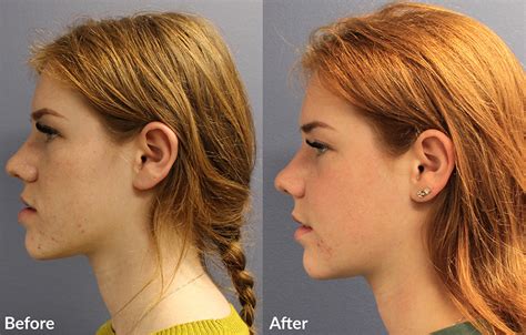 jaw surgery reddit|overbite corrective jaw surgery.